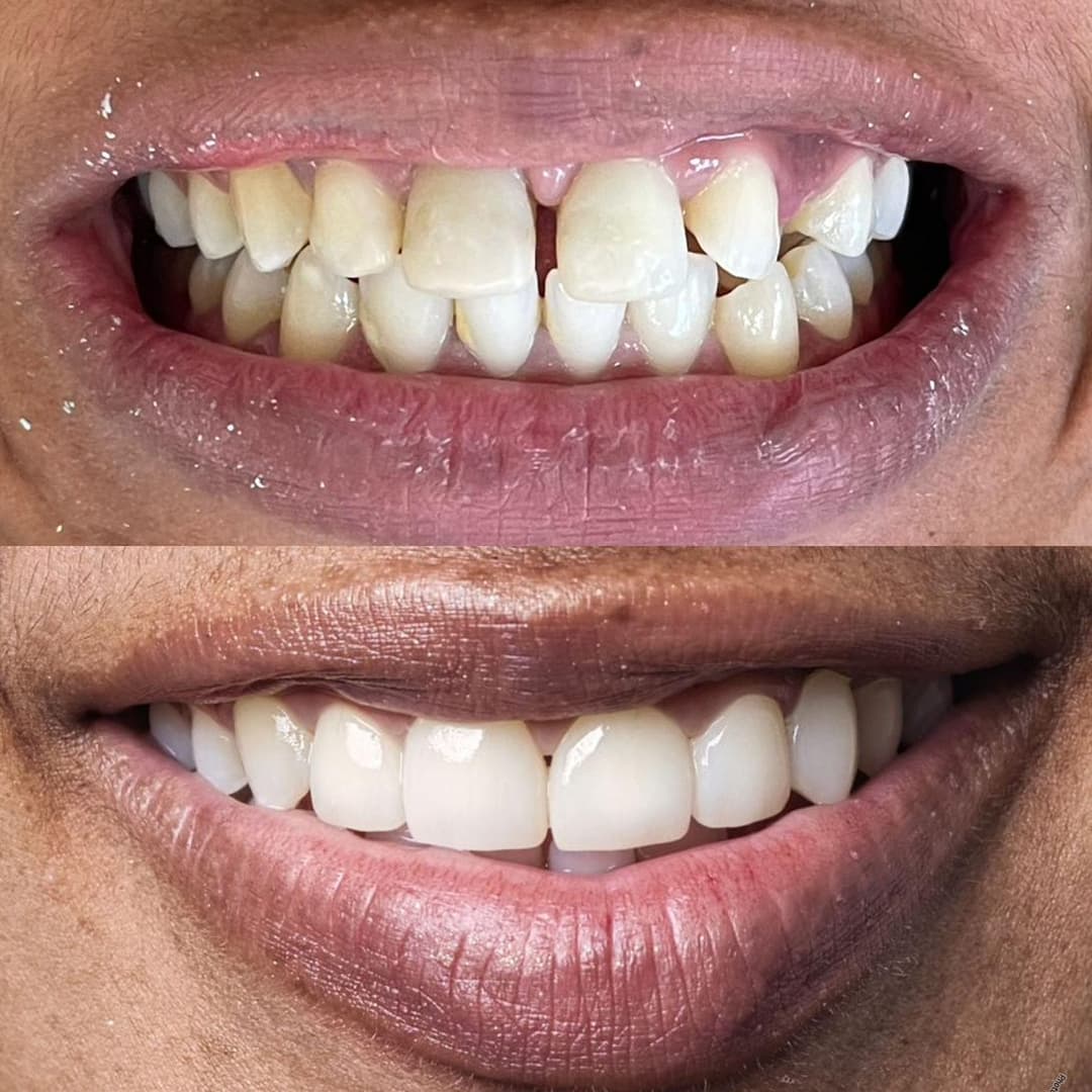 Anterior restoration before and after