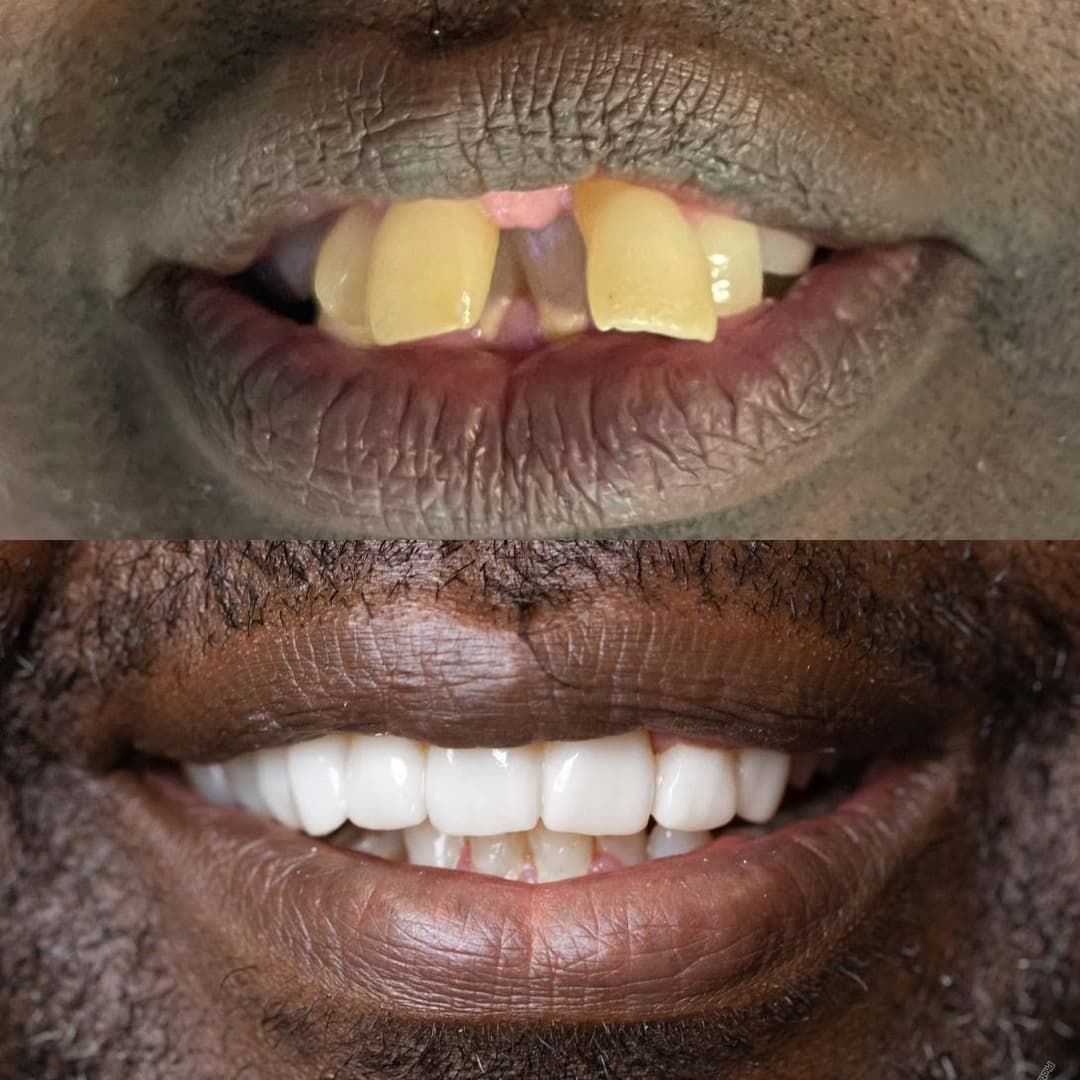 Cosmetic smile restoration before and after