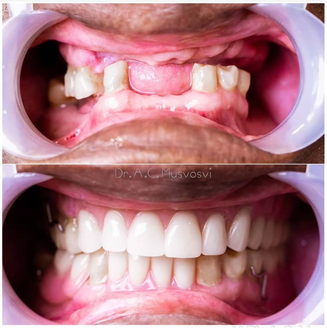 Anterior crowns before and after
