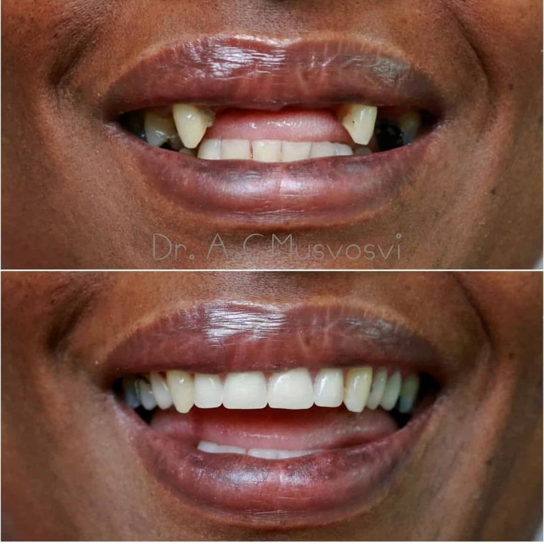 Full rehabilitation before and after